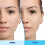 ژل ضد جوش دیفرین